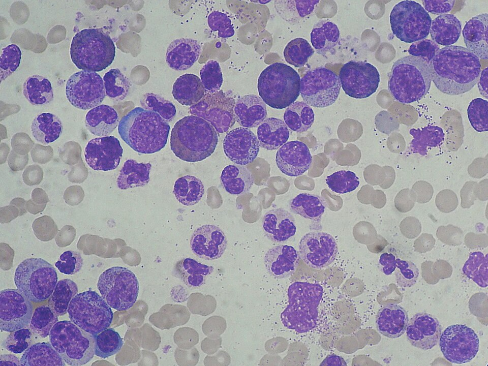 Peripheral blood smear showing numerous large, abnormal white blood cells (myeloid precursors) with dark purple nuclei among smaller pale red blood cells, characteristic of chronic myelogenous leukemia. Many leukocytes are visible. 